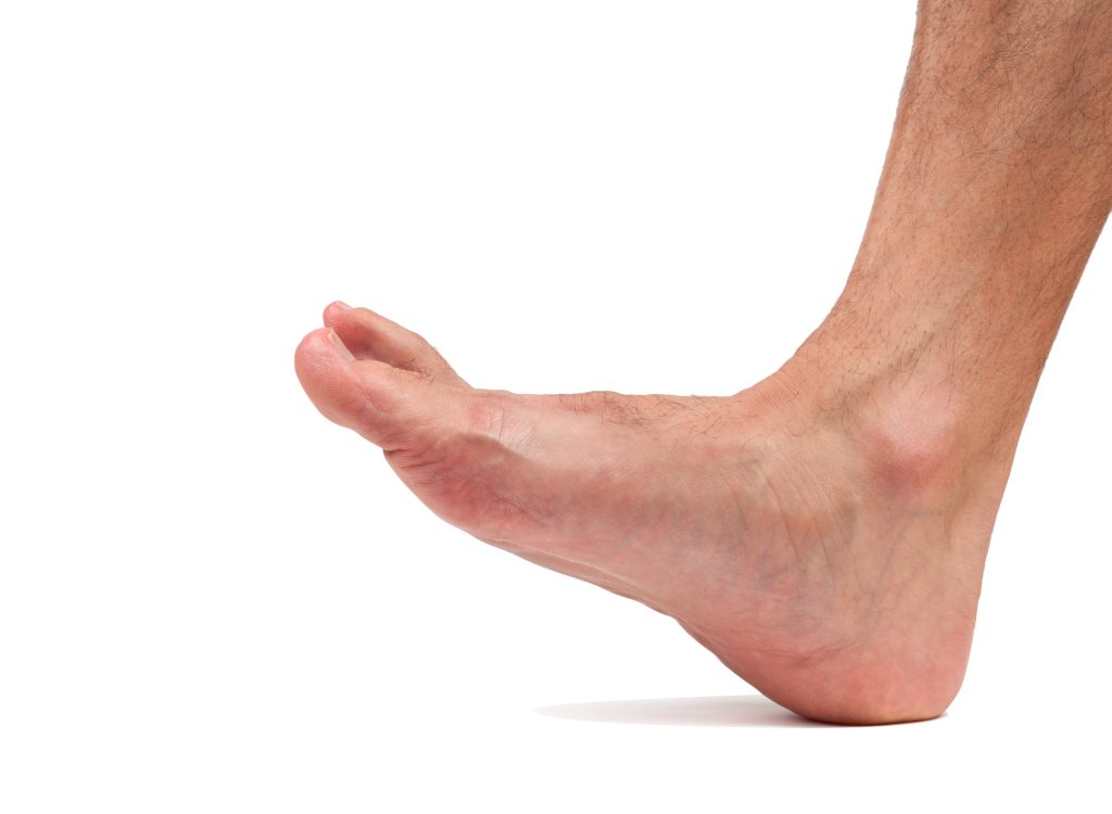 High Arches, Flat Feet Treatment in Sydney CBD, Chatswood