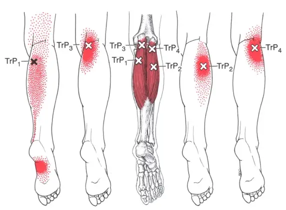Tight and Aching Leg Muscles - Functional Foot Rehab & Laser